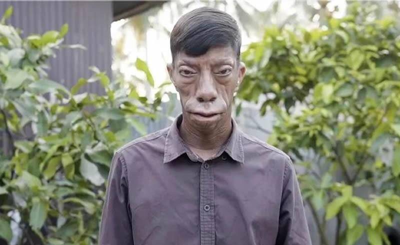 雷特综合症是什么病,雷特综合症是什么病的前兆
