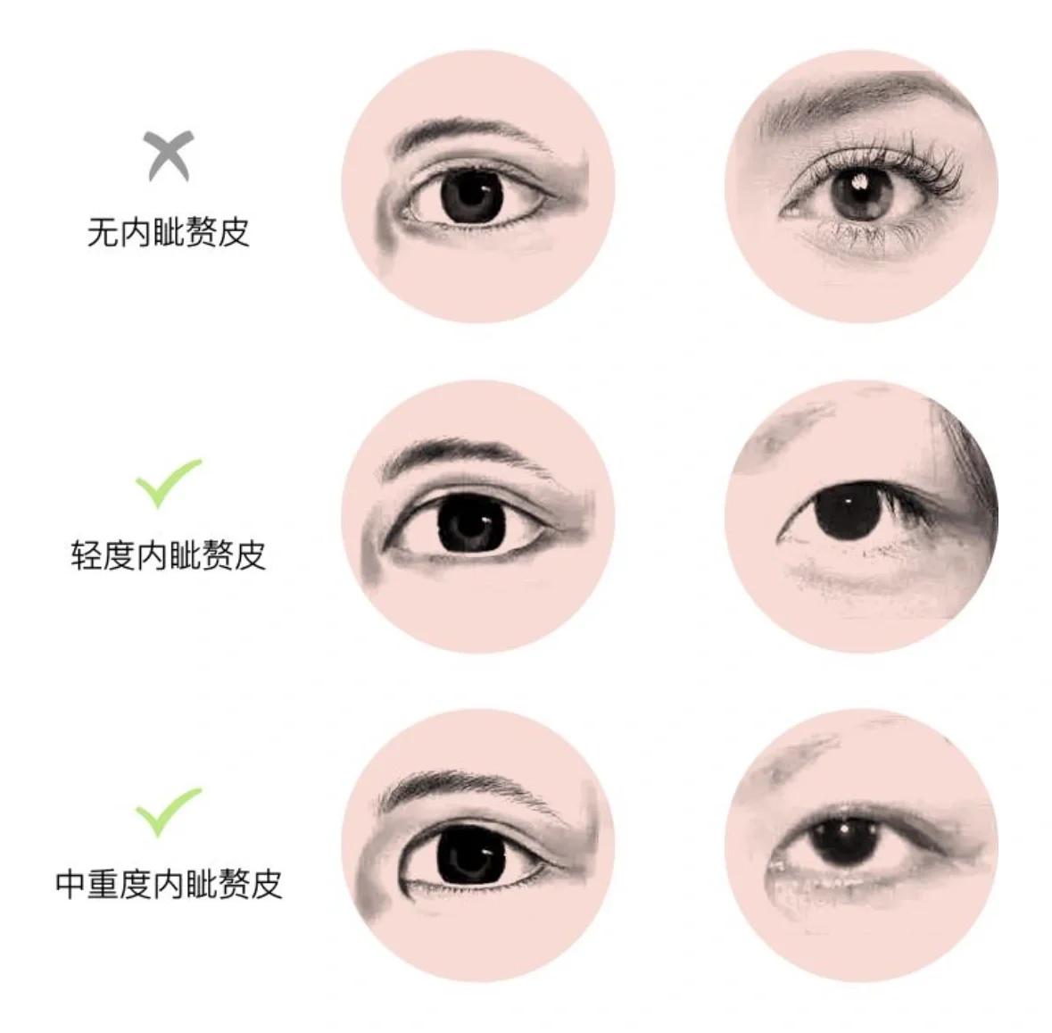 斗鸡眼什么原因造成的,斗鸡眼是什么病
