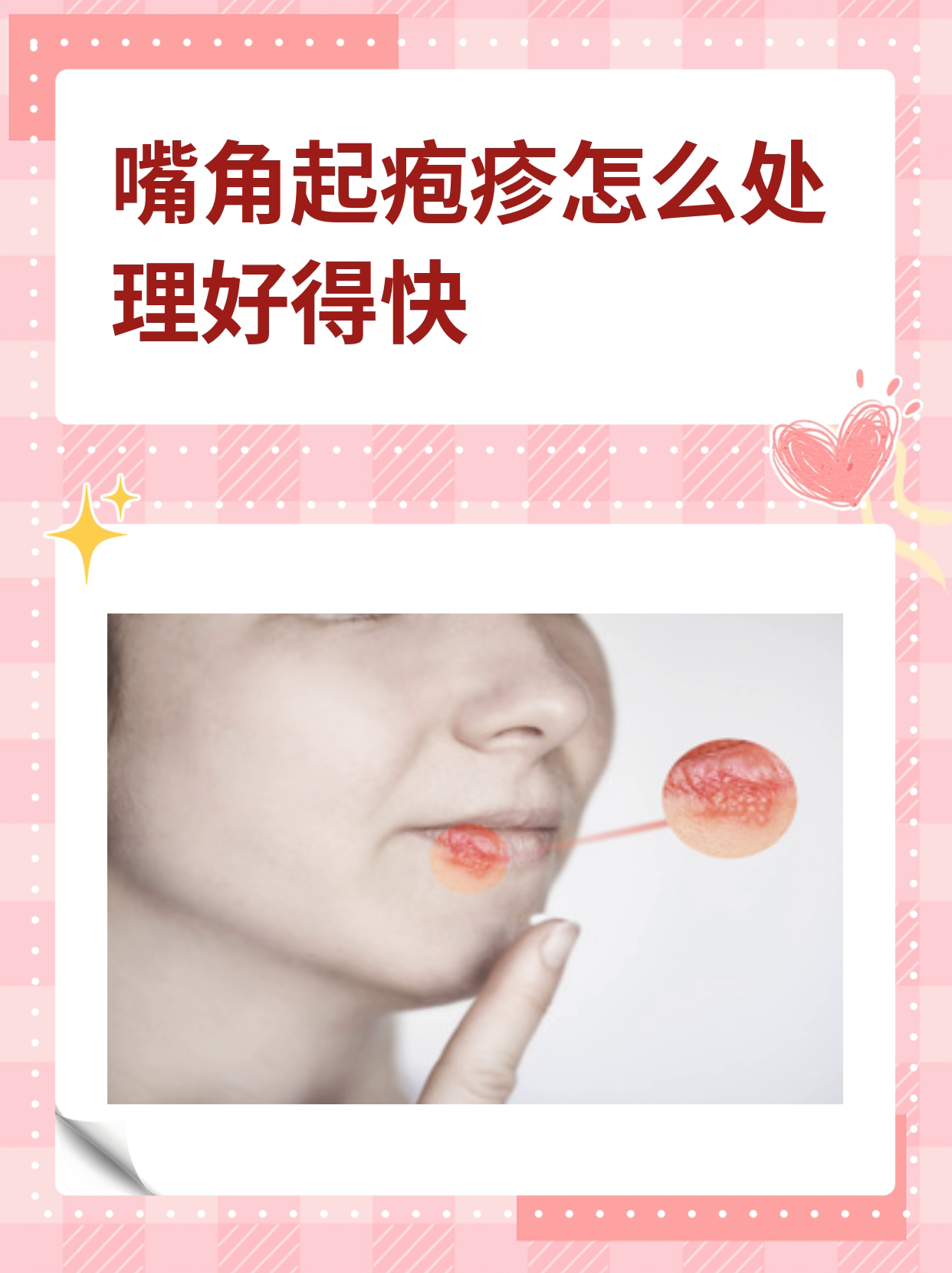 嘴角上火怎么办,嘴角上火怎么办最快最有效