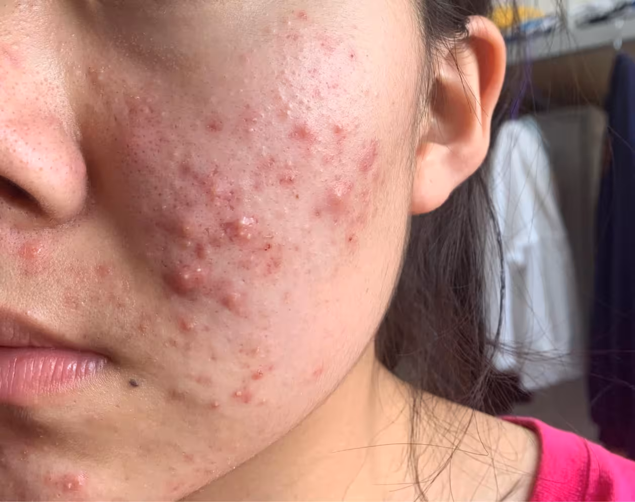 吃海鲜过敏怎么办,小孩吃海鲜过敏怎么办