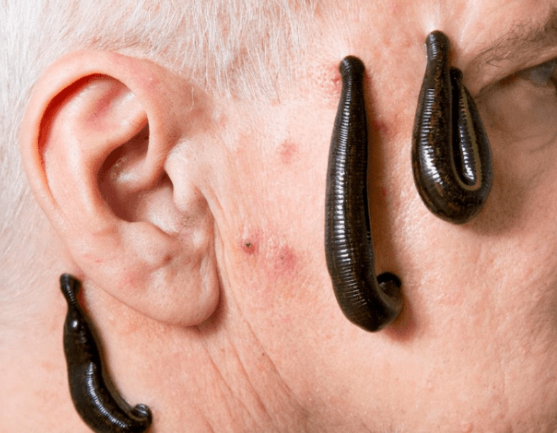 梦到从皮肤下拽出虫子的含义,梦见皮肤下有虫子蠕动又拽出来