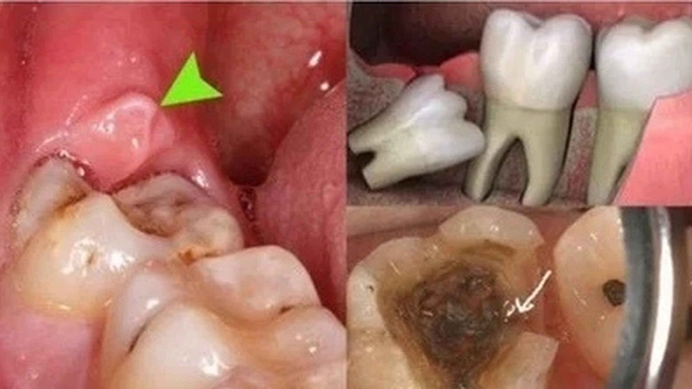什么是智齿,什么是智齿牙,需要拔吗?智齿有什么作用